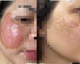 Chuyên gia giải mã loạt ca “hỏng da” vì trị nám sai cách