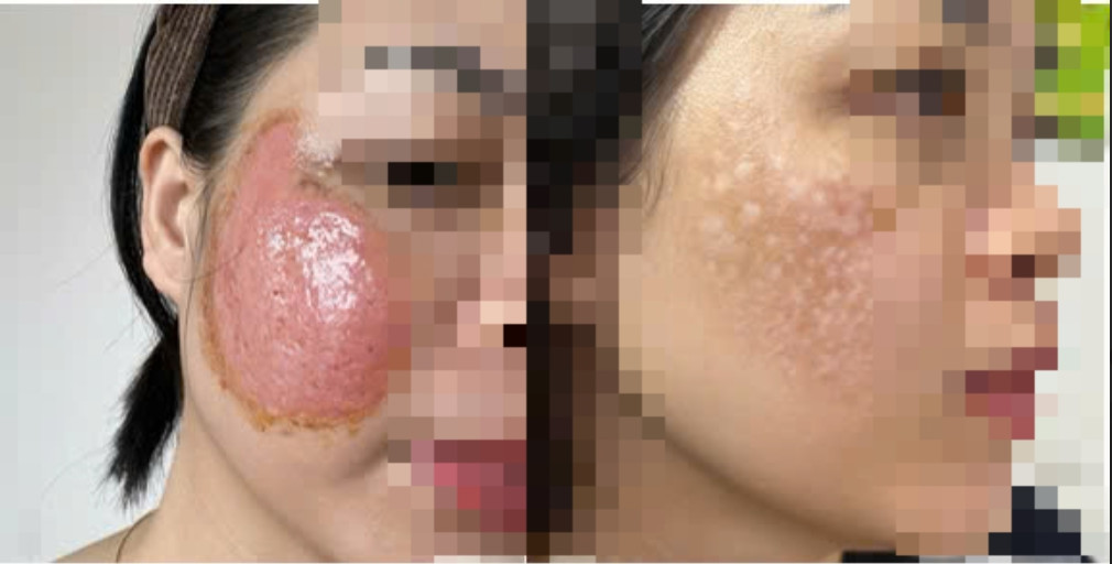 Chuyên gia giải mã loạt ca “hỏng da” vì trị nám sai cách